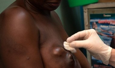 Abagabo barwaye Kanseri y'ibere ngo baribazi ko ituruka mu Mashereka gusa