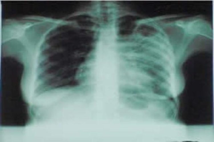 Mu Rwanda 60% by'abarwaye igituntu ntibajya kwa muganga kukivuza