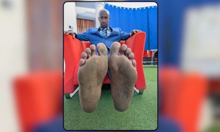 90% kwambara inkweto bitera uburwayi- Doctor umaze imyaka itandatu yambara ibirenge